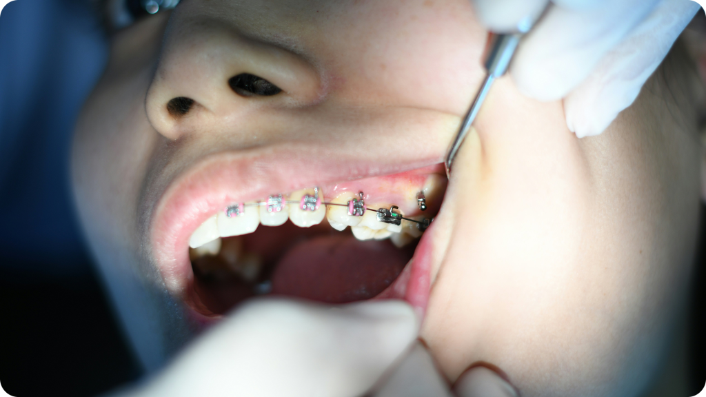 Care for teeth and gums